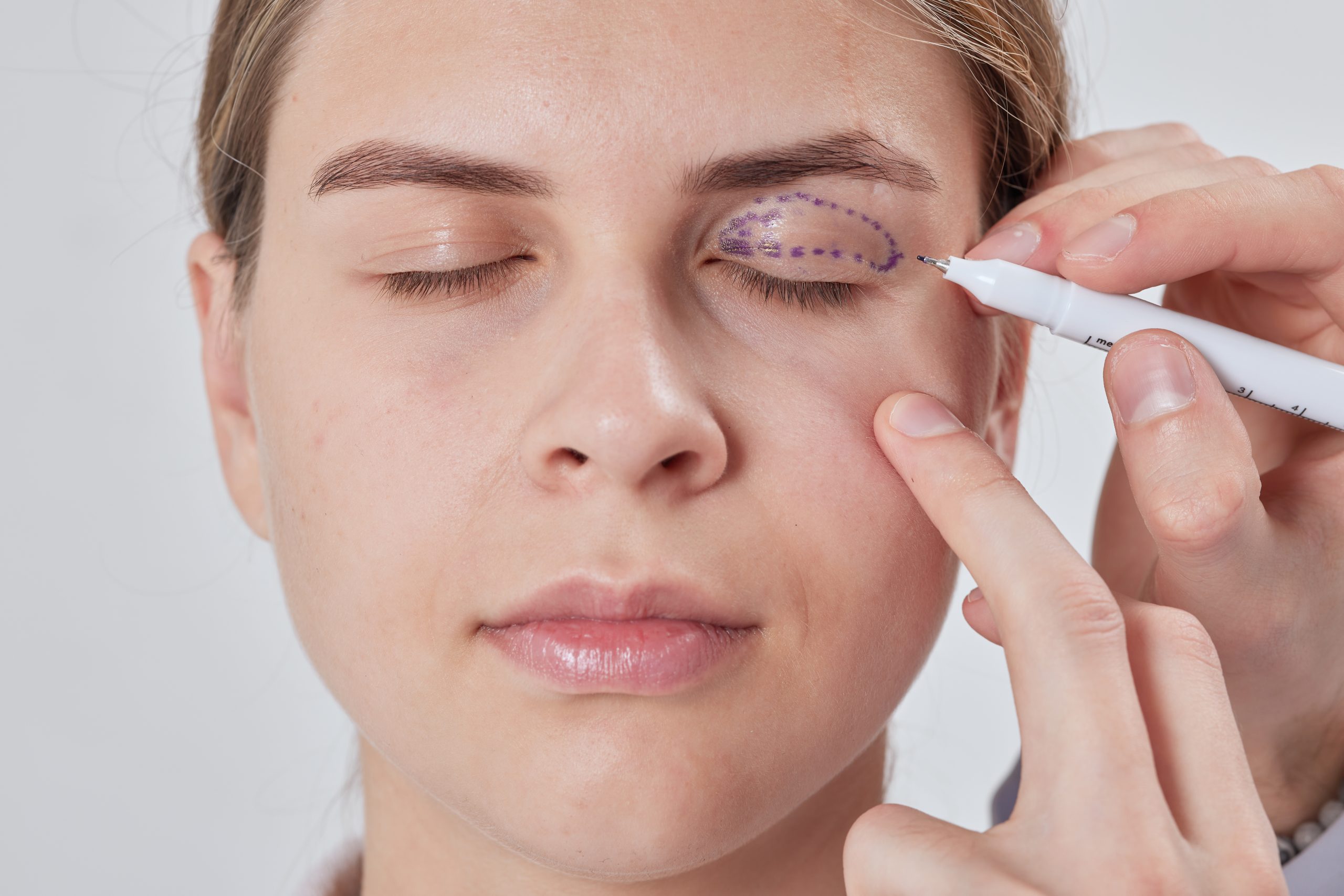 blefaroplastia en Girona