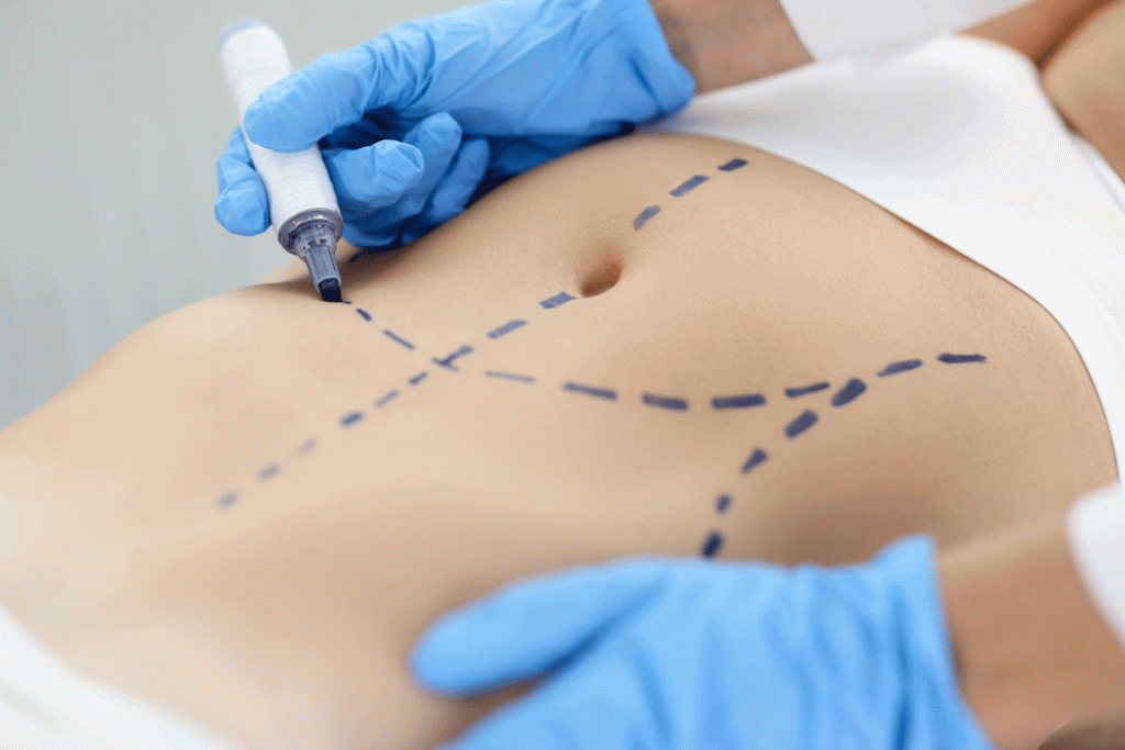 abdominoplàstia a Girona