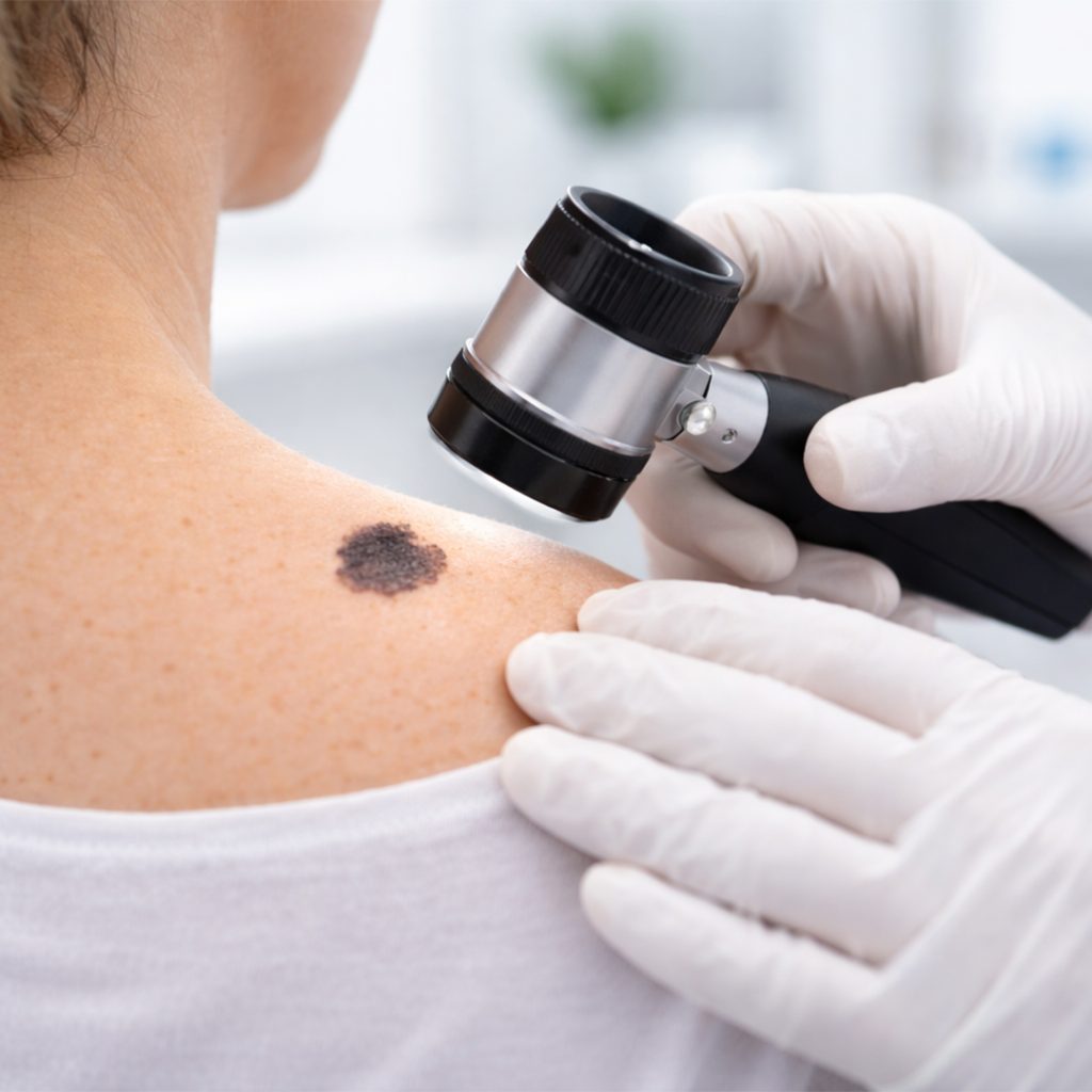 cirurgia oncològica cutània